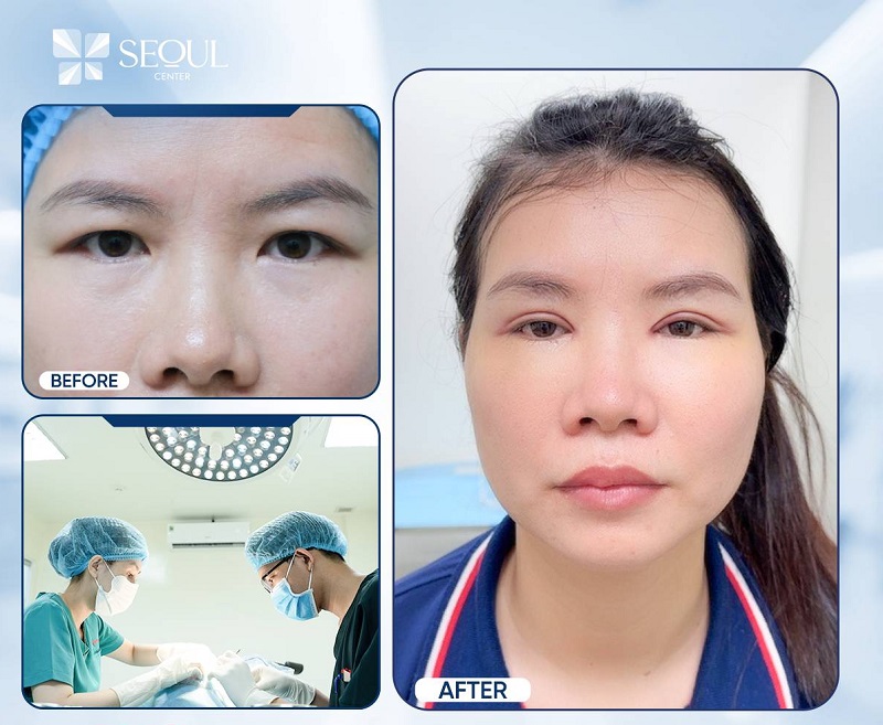 Những địa chỉ cắt mí mắt an toàn và chất lượng tại Biên Hòa