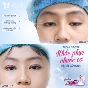 Seoul Center với những dịch vụ cắt mí chất lượng được khách hàng lựa chọn