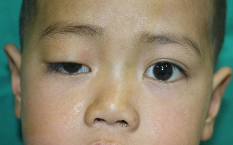 Mắt bên 1 mí bên 2 mí chủ yếu là do bẩm sinh từ trong bụng mẹ