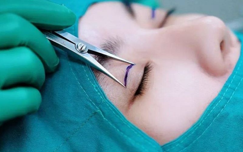 Hai bên mí mắt không đều nhau do thẩm mỹ mắt bị hỏng