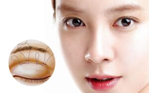 Nhấn mí mắt tạo mắt 2 mí long lanh, to tròn khắc phục được tình trạng mí mắt không đều