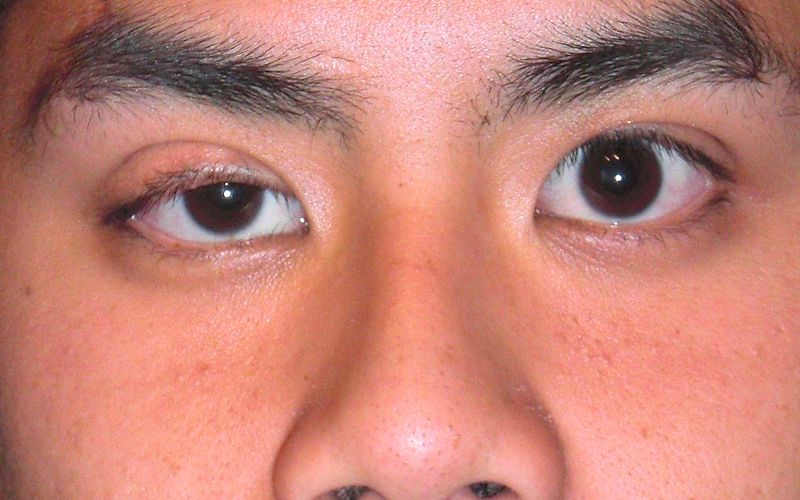 Nguyên nhân mắt không đồng đều thường do bẩm sinh, tai nạn