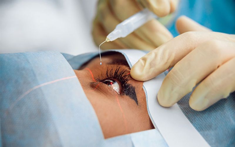 Mổ lé sử dụng chỉ thẩm mỹ tự tiêu nên không cần cắt chỉ