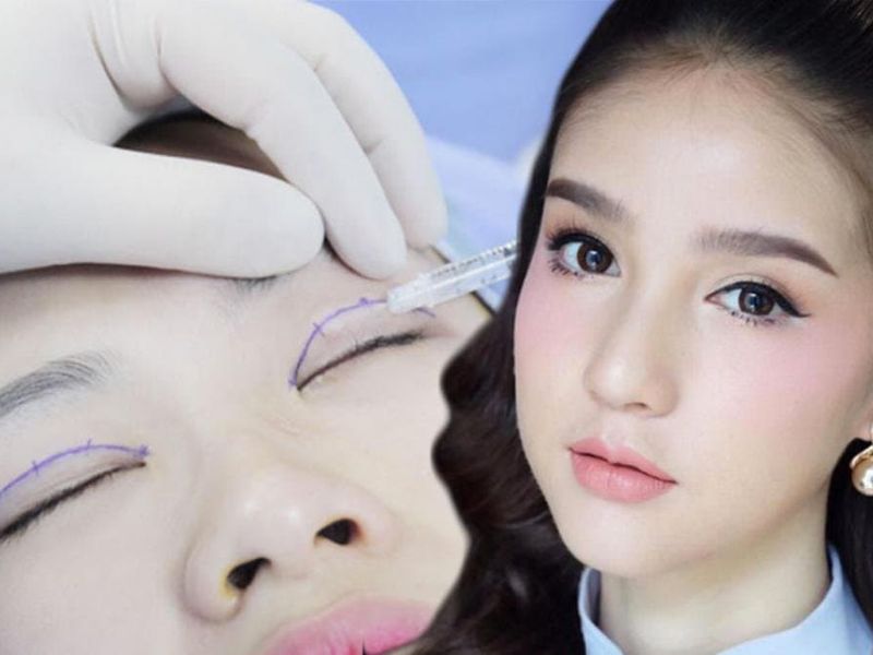 Cắt mí là cách làm mắt long lanh được chị em yêu thích nhất hiện nay