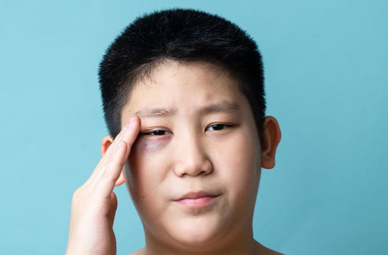 Bị bầm tím mắt có thể do va đập hoặc do cơ thể không đảm bảo sức khỏe