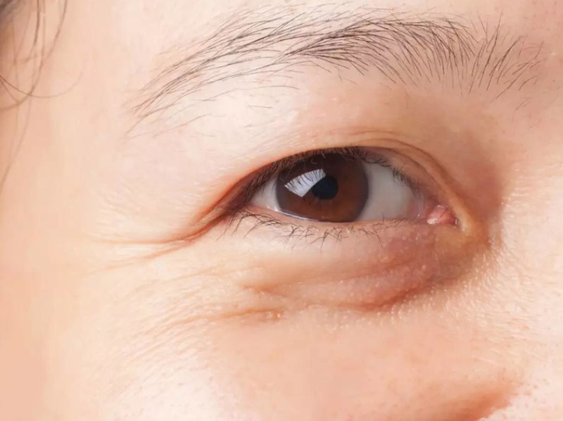 Một số căn bệnh về mắt có thể gây tích tụ mỡ mí mắt trên