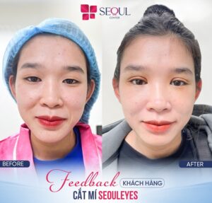 Cắt mí Mega Seoul Line có nhiều ưu điểm vượt trội
