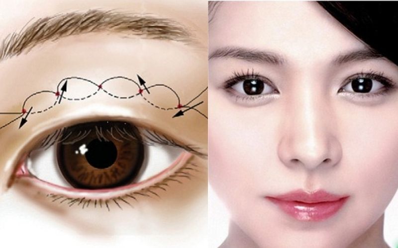 Chỉnh sửa mắt lá răm bằng phương pháp hiện đại