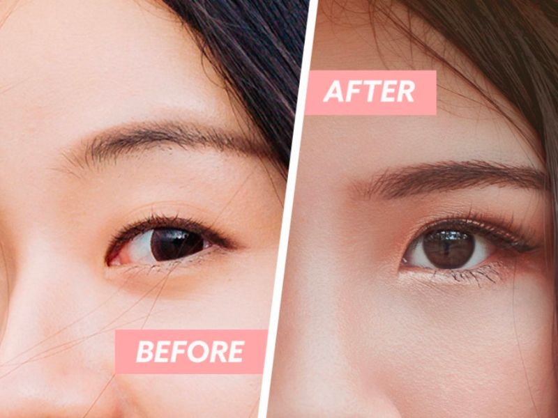 Nhấn mí là phương pháp làm đẹp luôn được chị em thảo luận sôi nổi