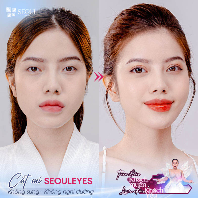 Bạn nên cắt mí nếu đang gặp phải các khuyết điểm về dáng mắt