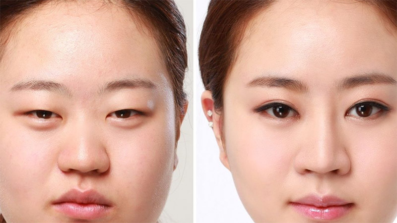 Cắt mí mắt khắc phục những đôi mắt có dấu hiệu bị sụp mí
