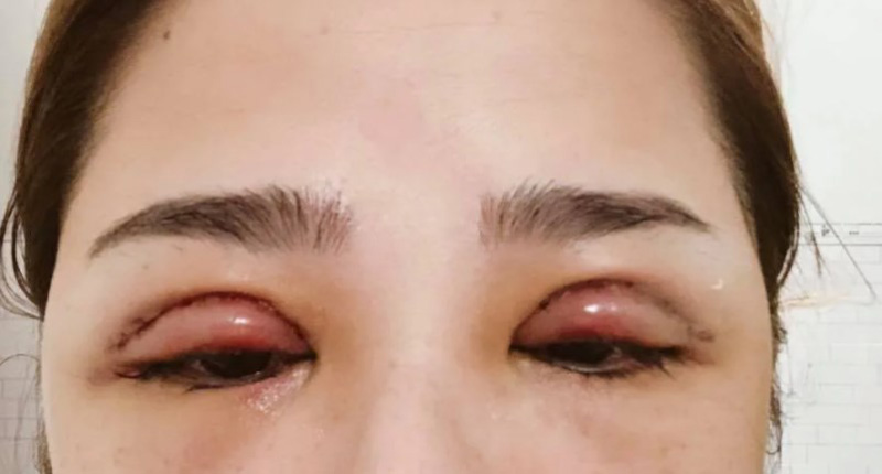 Sau khi cắt mí, vùng điều trị có thể bị sưng hoặc bầm tím