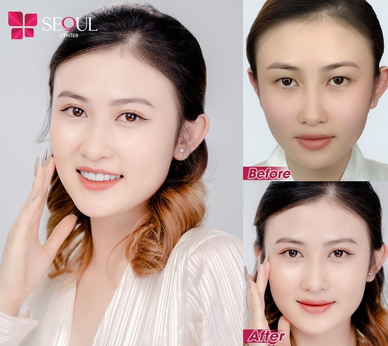 Seoul Center giúp khách hàng cải thiện đôi mắt một mí hiệu quả và an toàn