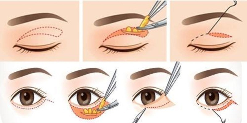 Quy trình cắt mí Eyelid chuẩn y khoa nhanh chóng, đơn giản