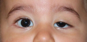 Sụp mí mắt bẩm sinh khiến cho 1 bên mắt to và 1 bên mắt nhỏ