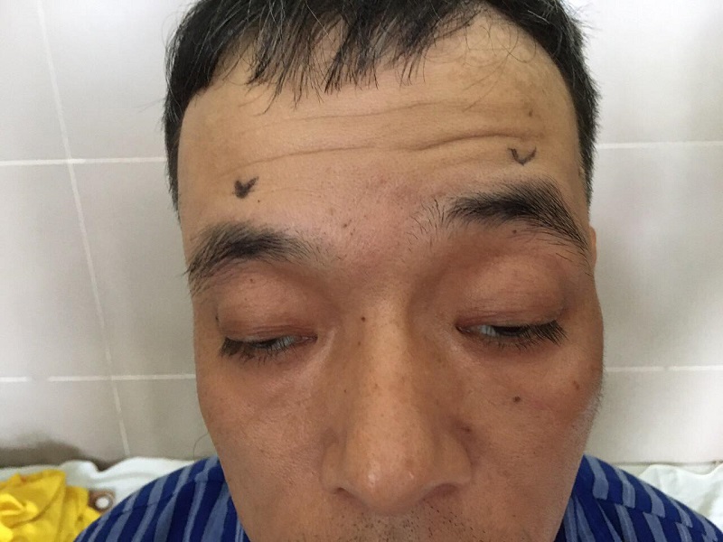 Khách hàng bị sụp mí mắt ảnh hưởng đến khả năng quan sát và gặp khó khăn trong sinh hoạt hàng ngày