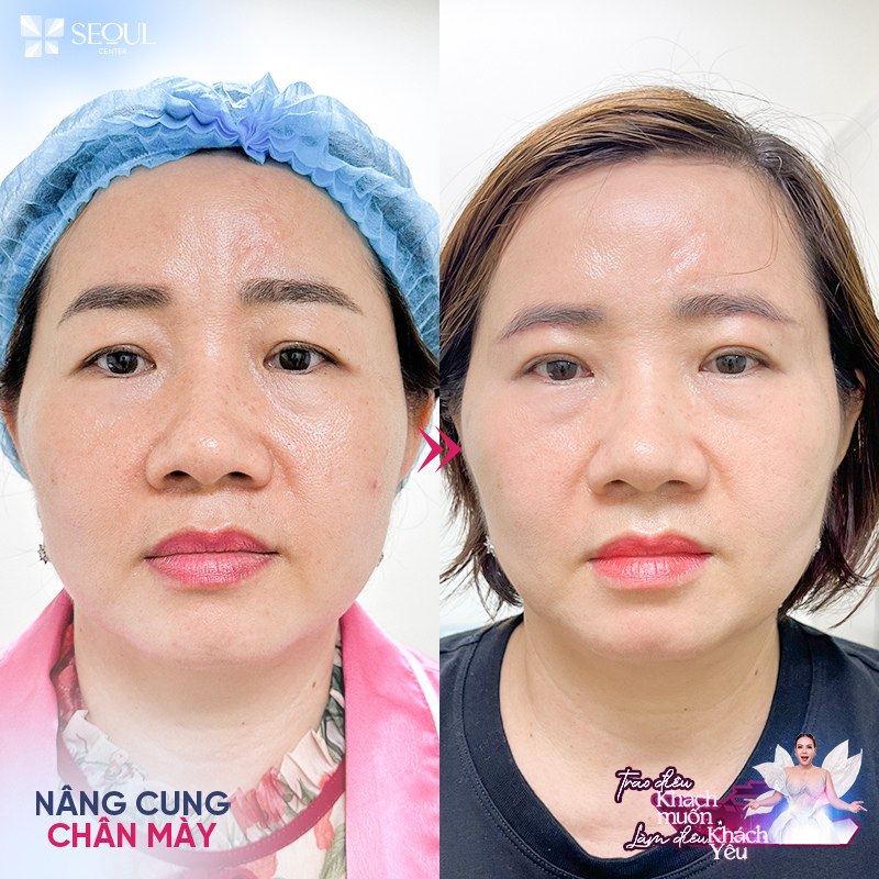 Nâng cung chân mày giúp khắc phục tình trạng cắt mí bị sụp, mang lại khuôn mặt trẻ trung và tươi tắn