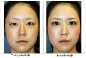 Cắt mí open mini là một gợi ý hoàn hảo để có một đôi mắt “biếc”