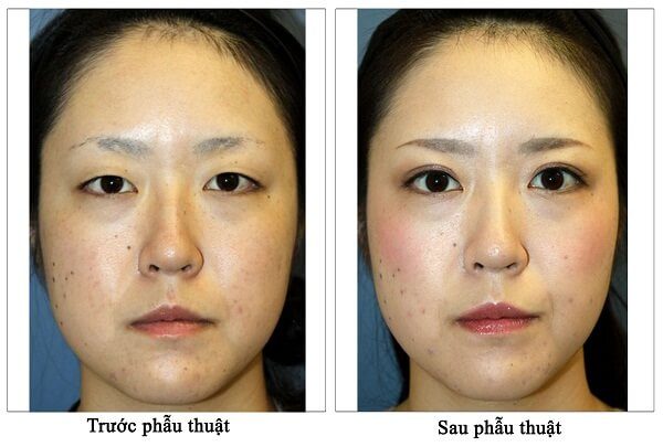 Cắt mí open mini là một gợi ý hoàn hảo để có một đôi mắt “biếc”