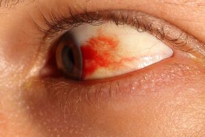 Tụ máu trong mắt tùy vị trí có mức độ nguy hiểm khác nhau