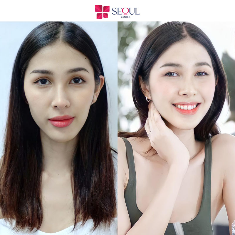 Khắc phục triệt để nhược điểm đôi mắt nhỏ, 1 mí kém thẩm mỹ
