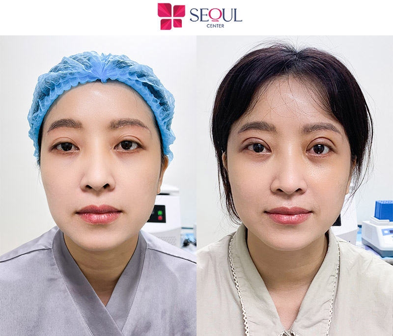 Đôi mắt hài hòa với đường nét gương mặt của bạn sau khi cắt mí
