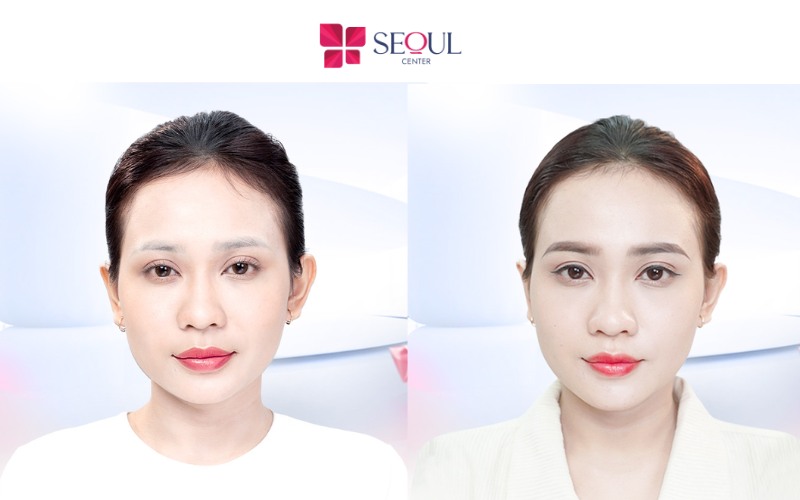 Mí mắt không quá sâu, hài hòa với tổng thể gương mặt