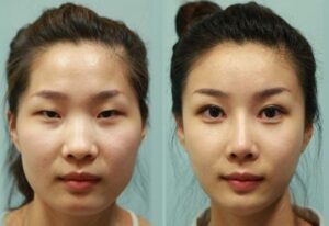 Hạ mắt xếch tại Seoul Center giúp thay đổi được tình trạng mắt xếch