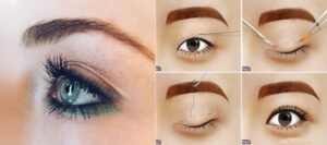 Quy trình thực hiện nhấn mí mắt