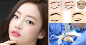 Chỉ cần từ 7 đến 10 ngày cắt mí sẽ hết sưng