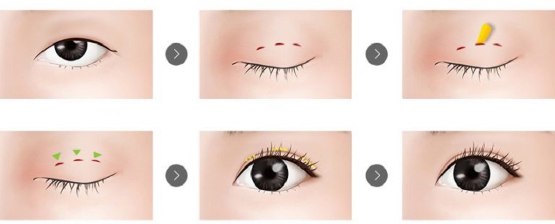 Bạn nên bấm mí nếu muốn khắc phục một số khuyết điểm nhỏ trên mắt