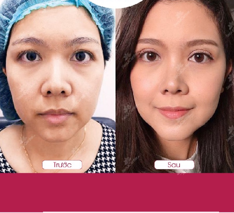   Chị N.T.Trinh 42 tuổi sở hữu được đôi mắt hai mí to tròn