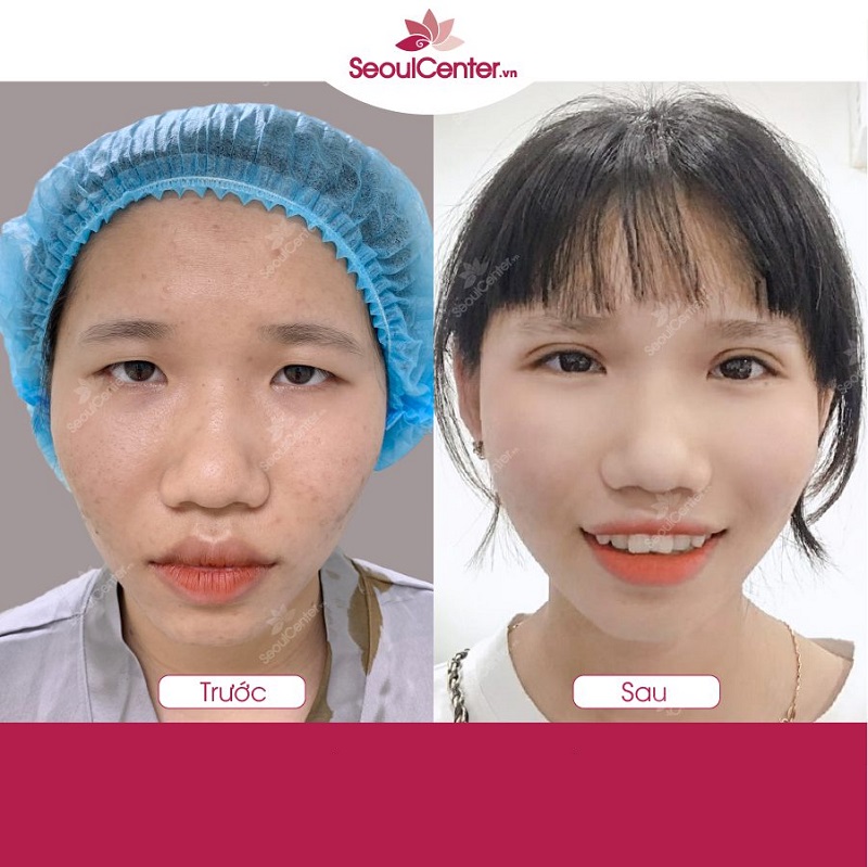 Chị H.T.N khôi phục được vẻ ngoài rạng rỡ nhớ bấm mí mắt Dove Eyes