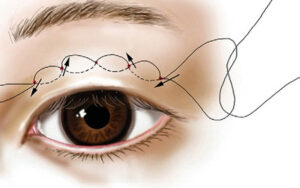 10 – 14 ngày là thời gian phổ biến để cắt chỉ mí mắt