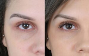 Tiêm filler bọng mắt cải thiện đáng kể lão hóa thường thấy ở vùng mắt