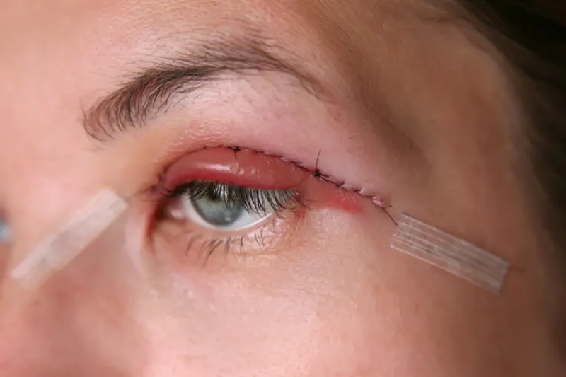 Sưng mí sau khi cắt mí là một phản ứng tự nhiên của cơ thể nên không cần quá lo lắng