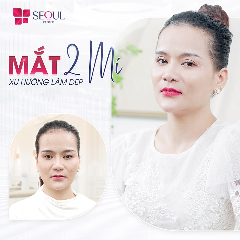 Phương pháp cắt mí Plasma đang là một trong những dịch vụ nổi bật tại Seoul Center Vĩnh Long