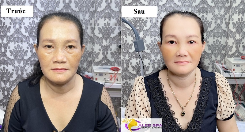 Khách hàng trải nghiệm dịch vụ cắt mí Hàn Quốc tại Calee Spa Beauty & Clinic