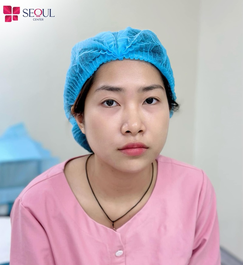 Một số khách hàng sau cắt mí gặp biến chứng hai mí không đều