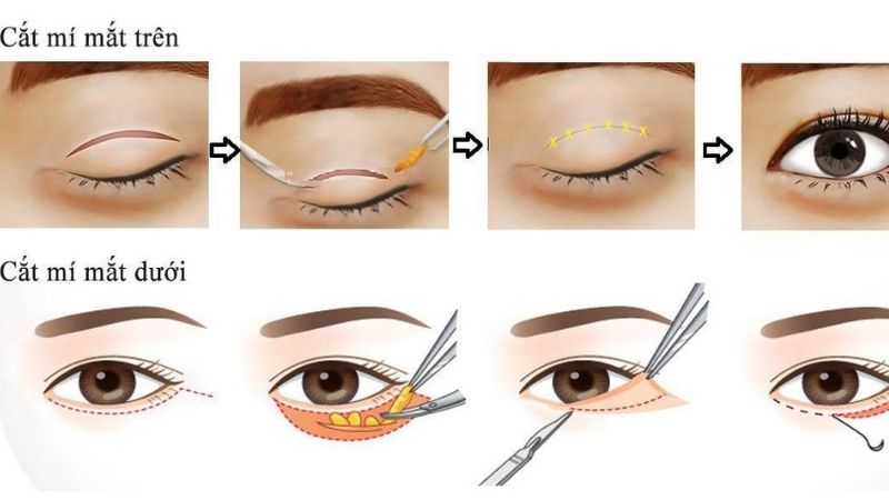   Cắt mí giúp loại bỏ các khuyết điểm trên mí mắt