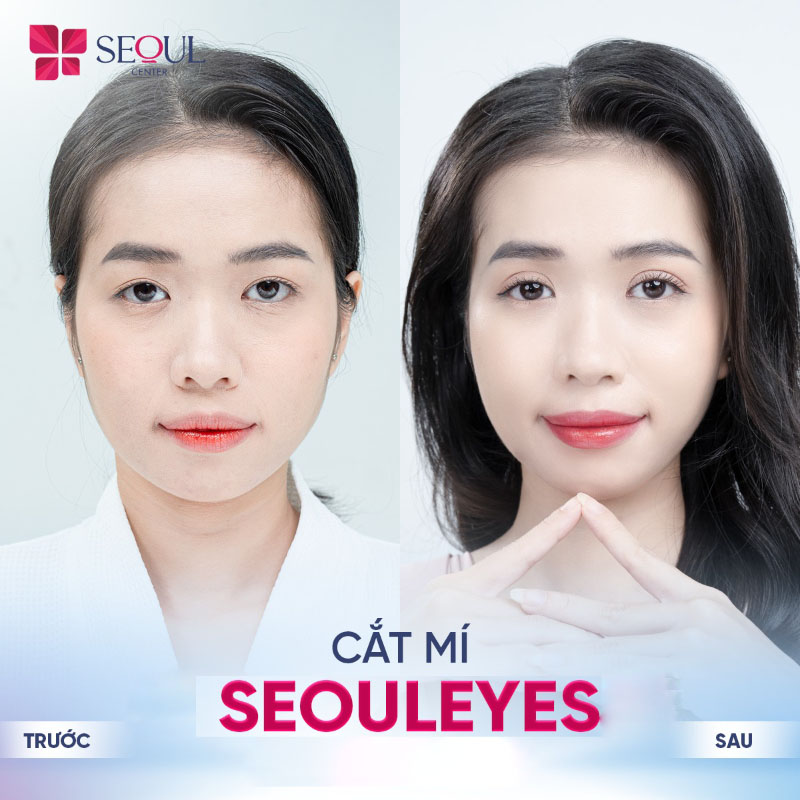 Đối tượng khách hàng phù hợp với phương pháp cắt mí