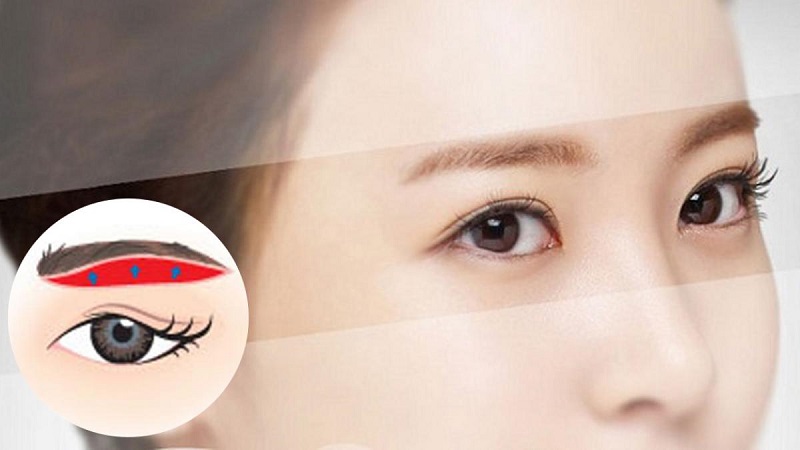 Cân nhắc kỹ khi lựa chọn giữa cắt mí hay nâng cung mày