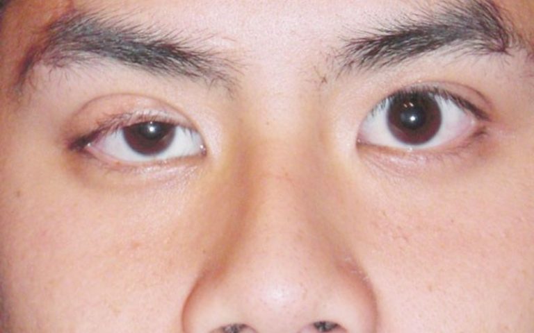   Tay nghề bác sĩ kém, cắt mí sai kỹ thuật khiến mí mắt không đều nhau