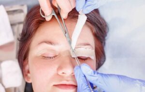 Cắt mí bị lệch do tay nghề của bác sĩ không đảm bảo kỹ thuật
