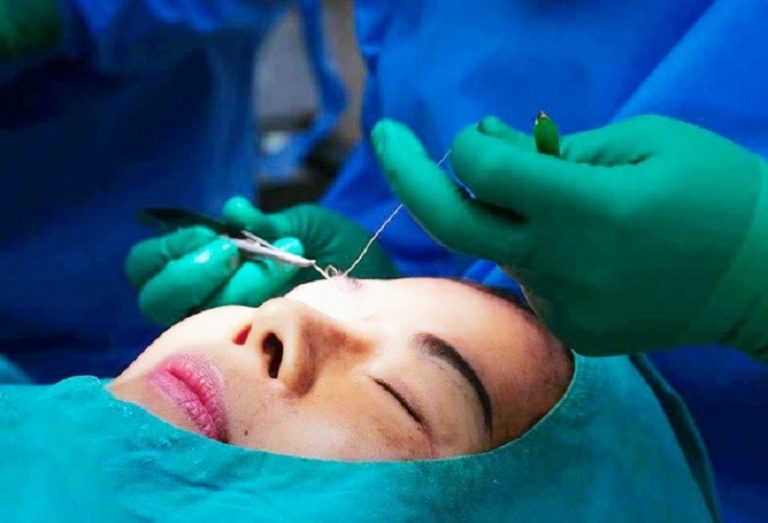 Tay nghề bác sĩ kém là nguyên nhân khiến cắt mí bị quá dài