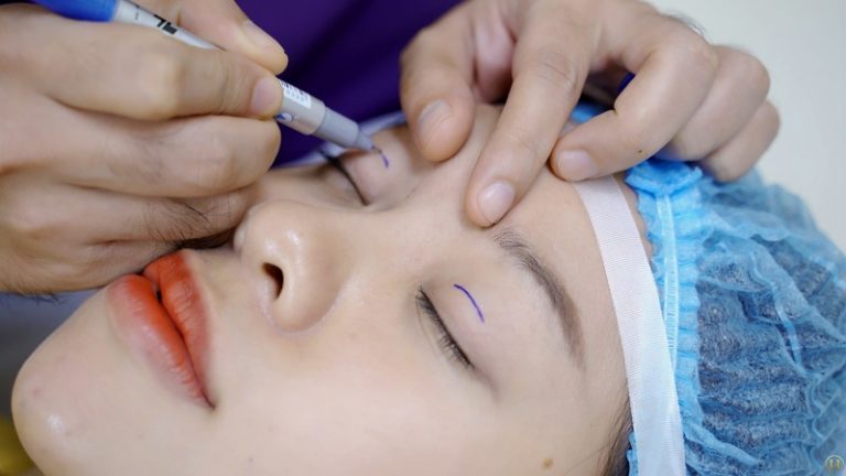   Thực hiện cắt mí bởi bác sĩ giỏi để phòng tránh cắt mí mắt bị dài