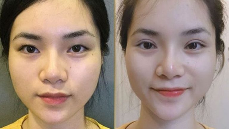 Khắc phục mí mắt lệch thành công tại Seoul Center