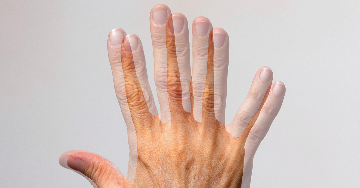 Chứng song thị xảy ra do nhiều nguyên nhân khác nhau