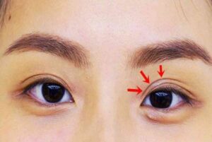 Nếp mí lót khiến đôi mắt kém to tròn và không cân đối