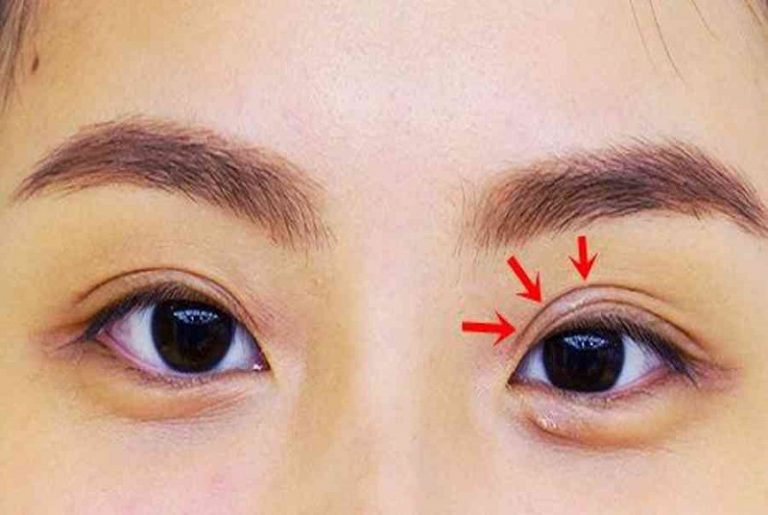 Nếp mí lót khiến đôi mắt kém to tròn và không cân đối